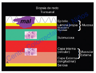 Biopsia de recto mal tomada: insuficiente o poco profunda para dar un diagnóstico