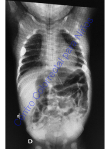 Radiografía posterior a la realización de las irrigaciones Radiografía posterior a la realización de las irrigaciones