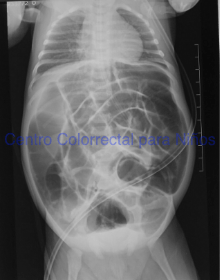 Radiografía previa a la realización de las irrigaciones Radiografía previa a la realización de las irrigaciones