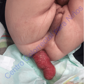 Prolapso de recto bebé