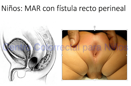Malformación anorrectal con fístula recto perineal en niños