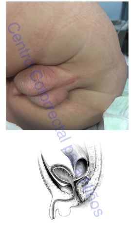 Malformación anorrectal con fístula al cuello vesical