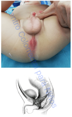 Malformación anorrectal con fístula recto uretro-bulbar