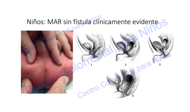 Malformaciones anorrectales en niños