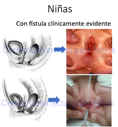 Malformaciones anorrectales en niñas con fístula