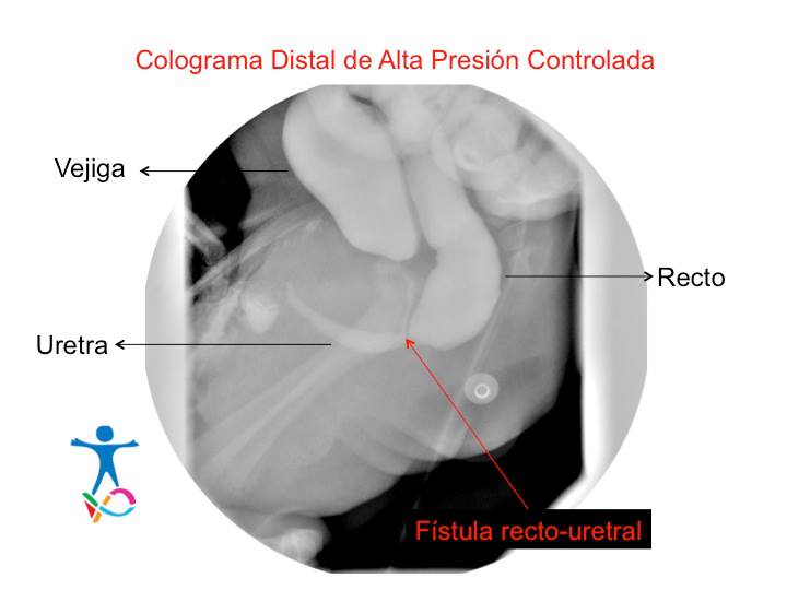 Estudio de colograma distal de alta presión