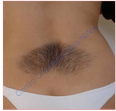 Vello en región lumbar Vello en región lumbar