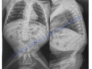Síndrome de regresión caudal tipo IV Síndrome de regresión caudal tipo IV