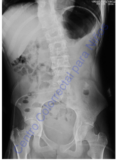 Agenesia total de sacro (síndrome de regresión caudal tipo III) Agenesia total de sacro (síndrome de regresión caudal tipo III)