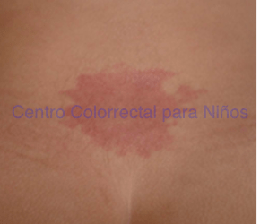 Malformación vascular Malformación vascular