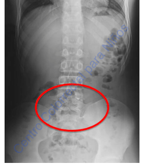 Radiografía de espina bífida oculta Radiografía de espina bífida oculta