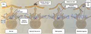 Tipos de defectos del tubo neural