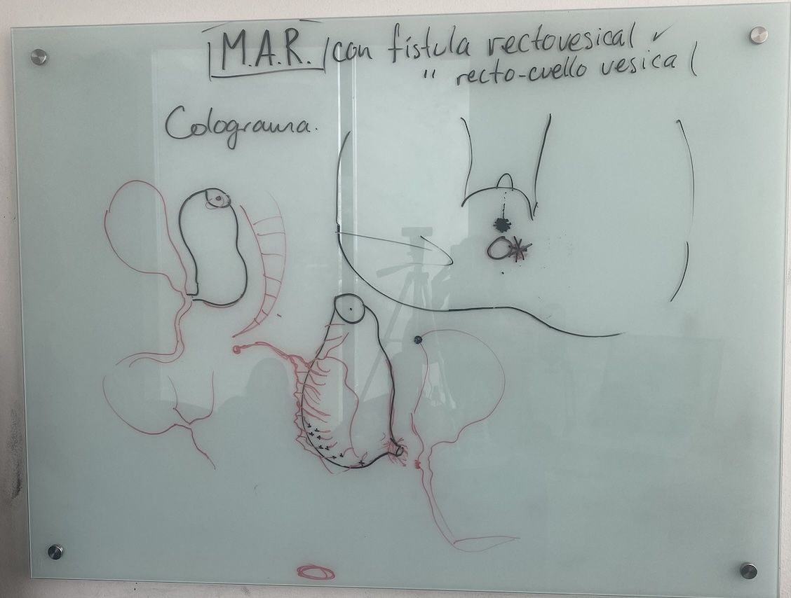 Resumen de nuestra clase "Malformación anorrectal con fístula recto cuello vesical"